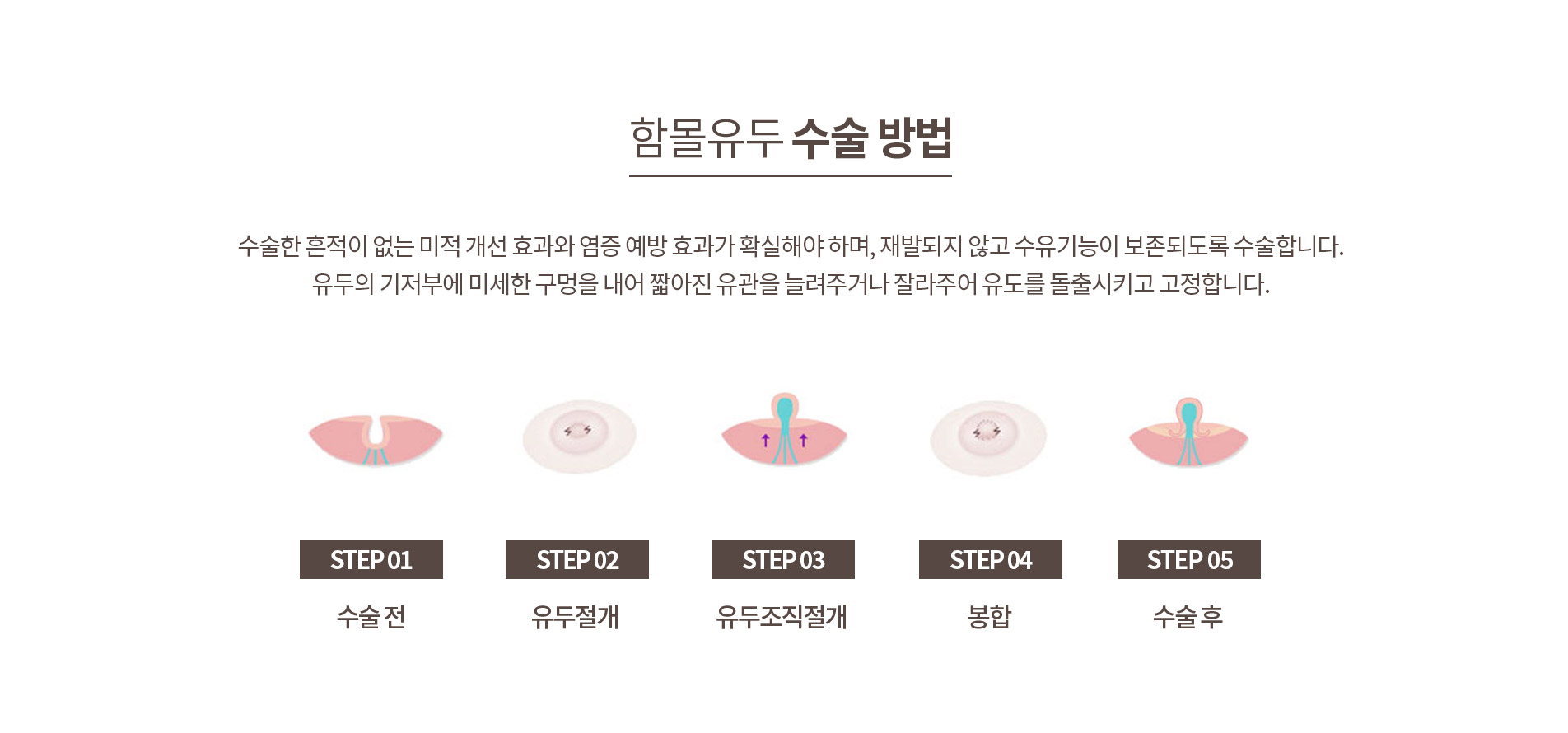 부유방·함몰유두 