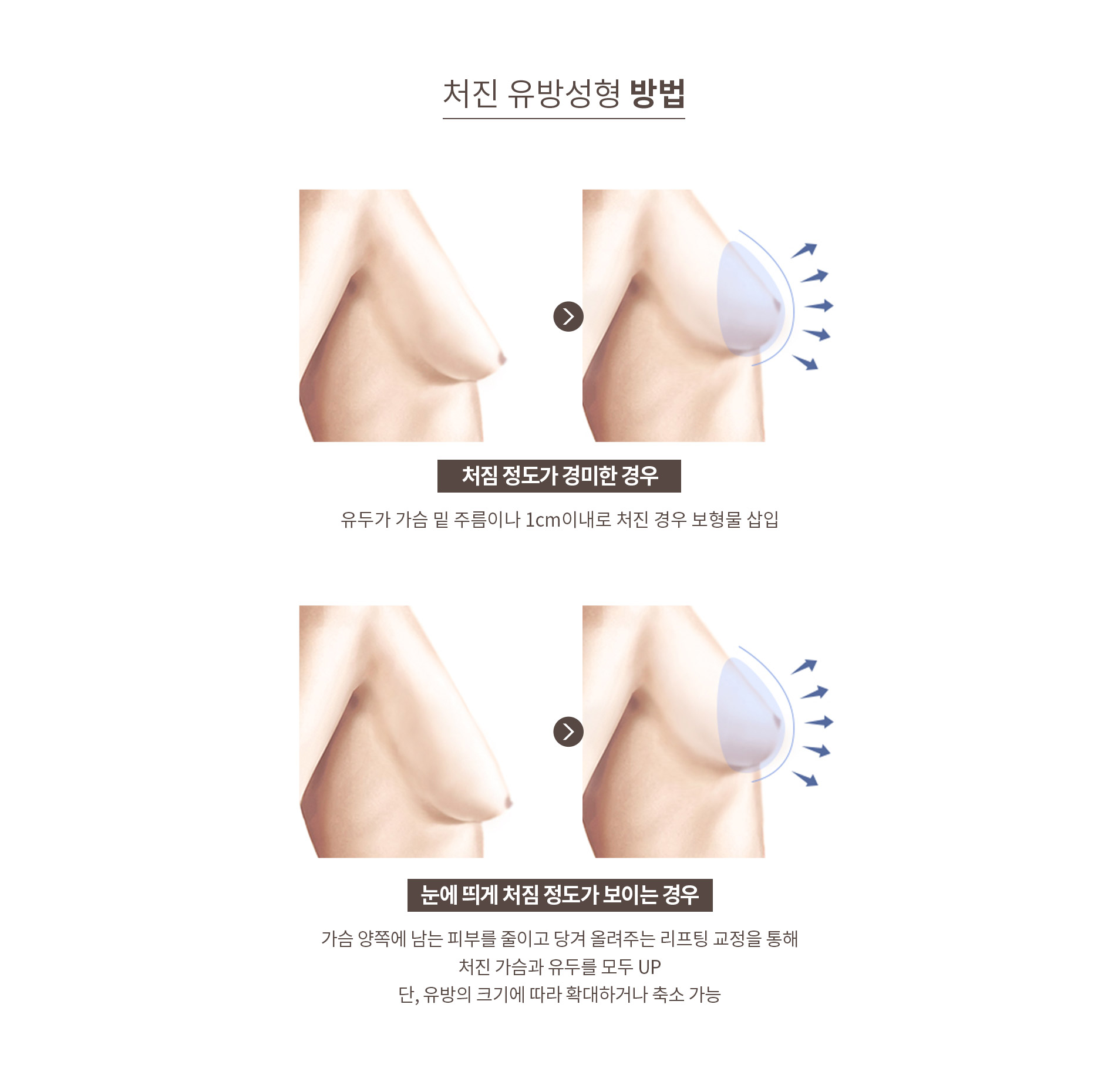 처진유방성형 