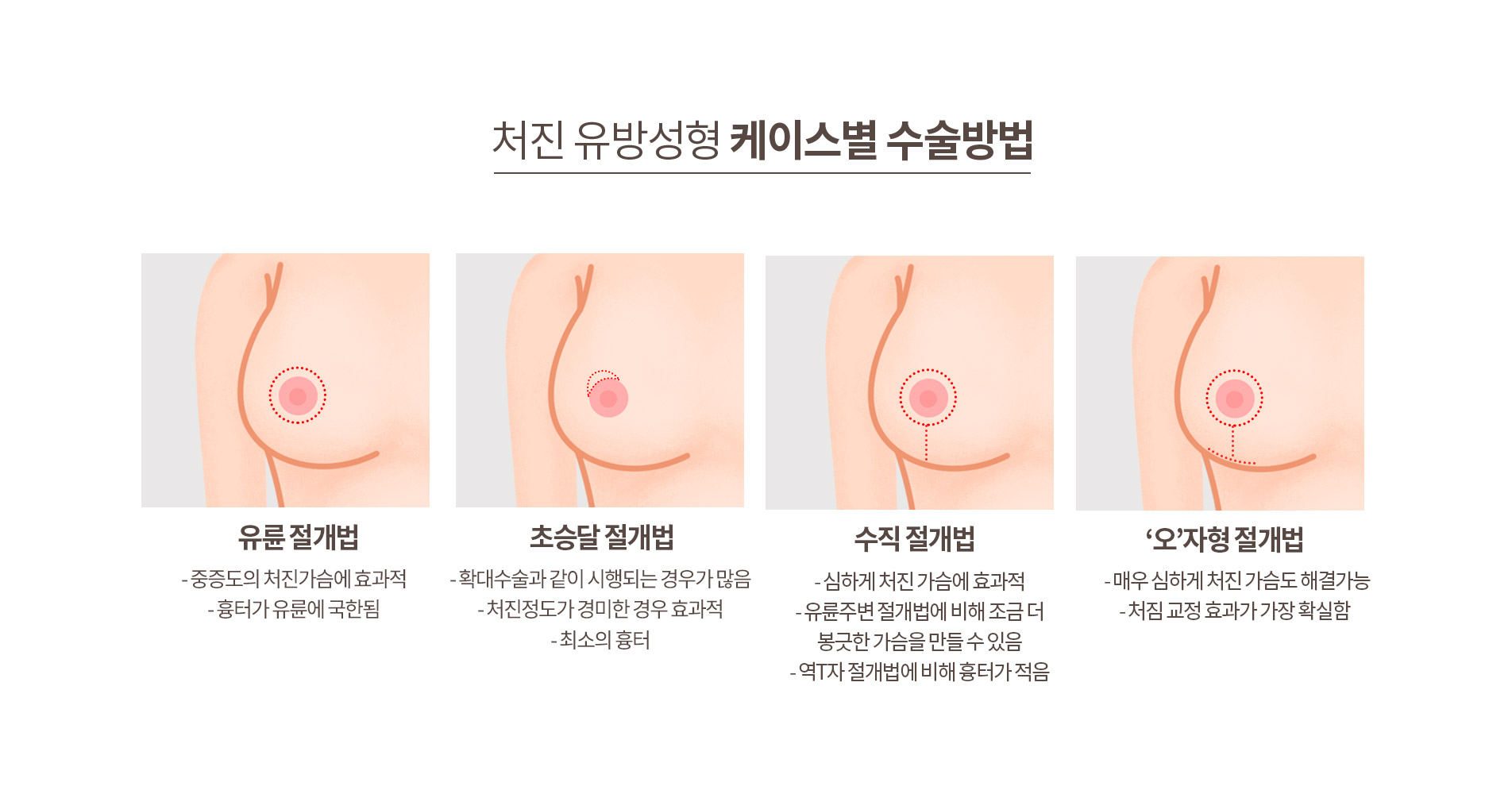 처진유방성형 