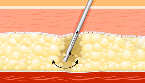 오케이 지방이식